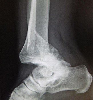 Forward Dislocation of the Ankle