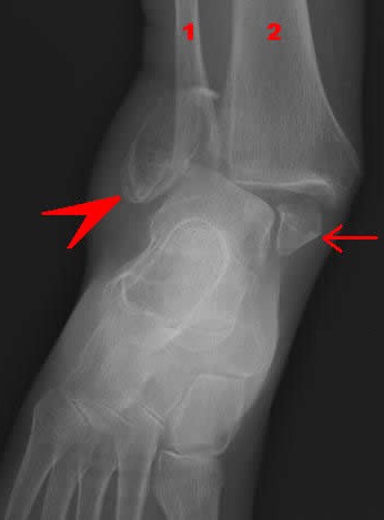 Biomalleolar Fracture