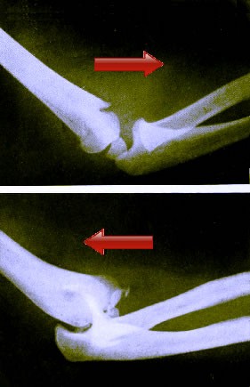 Dislocated Elbow X-Rays
