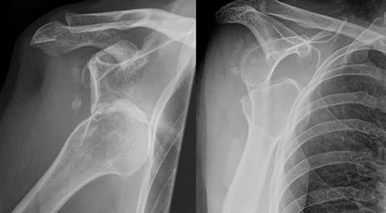 X-Ray of Dislocated Shoulder