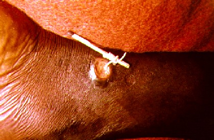 Extracting a Guinea Worm+