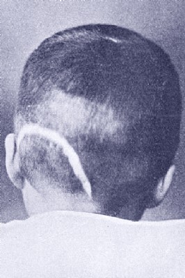 Scar Formation After Head Surgery