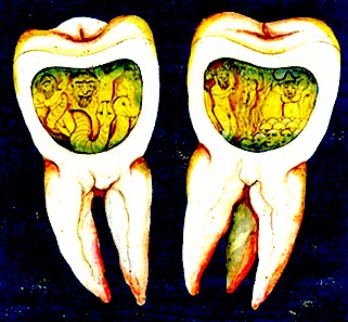 Toothworms