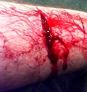 Bleeding Wound