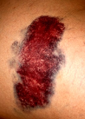 Bruise on the Upper Leg