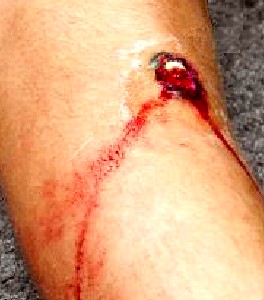 Bullet Wound to Leg