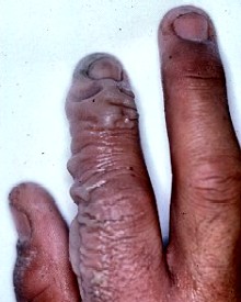 Burn Blisters on Finger