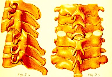 Dislocated Lumbar Vertebra