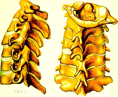 Dislocated Neck Verebrae