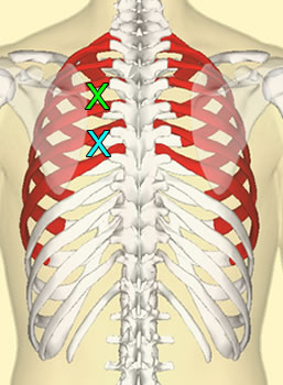 Incision Location Back