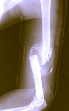 X-Ray of Fracture with Slivers