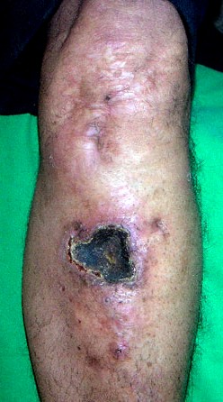 Gangrenous Leg Wound