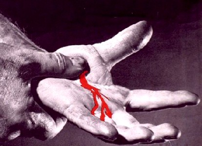 Stopping Bleeding in the Hand