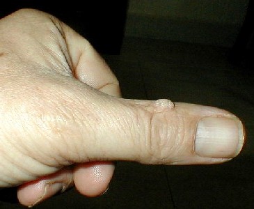 Wart on Thumb