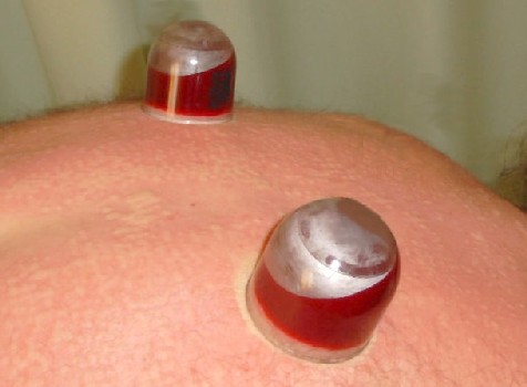 Wet Cupping