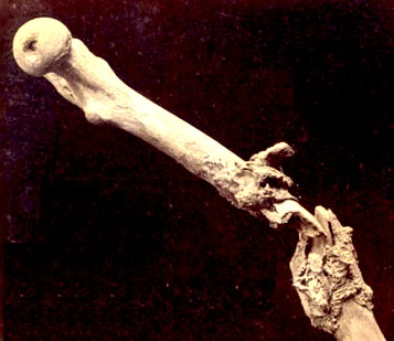 Bone Exfoliation and Necrosis